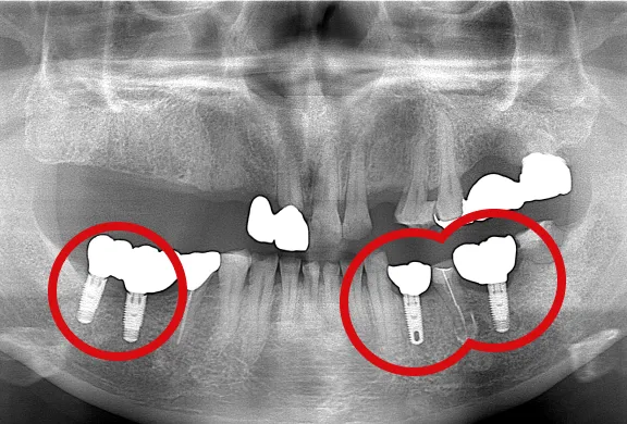 下顎のインプラント