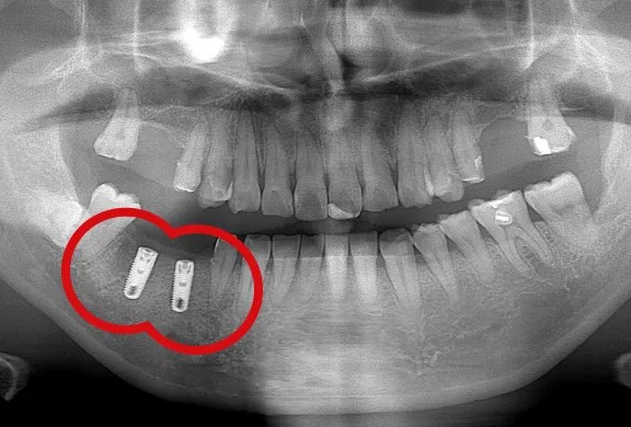 下顎のインプラント(2本)